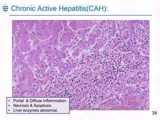 34
Chronic Active Hepatitis(CAH):
• Portal & Diffuse Inflammation.
• Necrosis & Apoptosis.
• Liver enzymes abnormal.
 