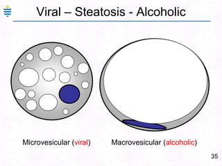 35
Viral – Steatosis - Alcoholic
Microvesicular (viral) Macrovesicular (alcoholic)
 