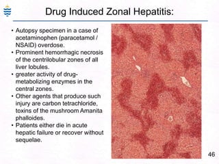 Drug Induced Zonal Hepatitis:
46
• Autopsy specimen in a case of
acetaminophen (paracetamol /
NSAID) overdose.
• Prominent hemorrhagic necrosis
of the centrilobular zones of all
liver lobules.
• greater activity of drug-
metabolizing enzymes in the
central zones.
• Other agents that produce such
injury are carbon tetrachloride,
toxins of the mushroom Amanita
phalloides.
• Patients either die in acute
hepatic failure or recover without
sequelae.
 