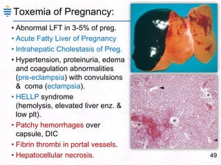 Toxemia of Pregnancy:
49
• Abnormal LFT in 3-5% of preg.
• Acute Fatty Liver of Pregnancy
• Intrahepatic Cholestasis of Preg.
• Hypertension, proteinuria, edema
and coagulation abnormalities
(pre-eclampsia) with convulsions
& coma (eclampsia).
• HELLP syndrome
(hemolysis, elevated liver enz. &
low plt).
• Patchy hemorrhages over
capsule, DIC
• Fibrin thrombi in portal vessels.
• Hepatocellular necrosis.
 