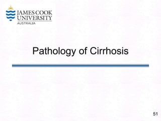 51
Pathology of Cirrhosis
 