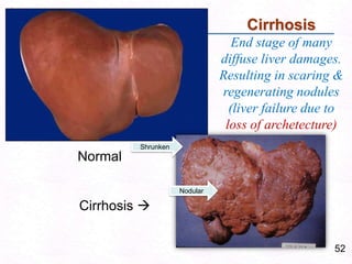 52
Normal
Cirrhosis 
Cirrhosis
End stage of many
diffuse liver damages.
Resulting in scaring &
regenerating nodules
(liver failure due to
loss of archetecture)
Nodular
Shrunken
 