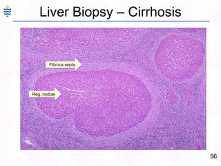 56
Liver Biopsy – Cirrhosis
Reg. nodule
Fibrous septa
 