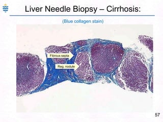 57
Liver Needle Biopsy – Cirrhosis:
(Blue collagen stain)
Reg. nodule
Fibrous septa
 
