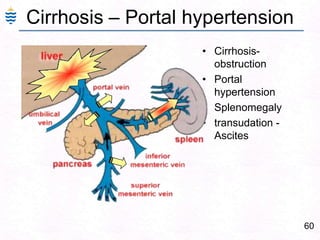 60
Cirrhosis – Portal hypertension
• Cirrhosis-
obstruction
• Portal
hypertension
• Splenomegaly
• transudation -
Ascites
 