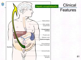 61
Clinical
Features
Hepatic encephalopathy
 