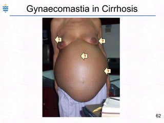 62
Gynaecomastia in Cirrhosis
??
?
?
 