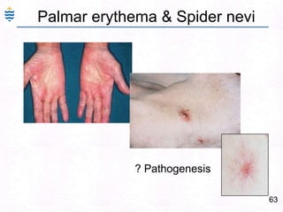 63
Palmar erythema & Spider nevi
? Pathogenesis
 