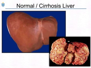 66
Normal / Cirrhosis Liver
 