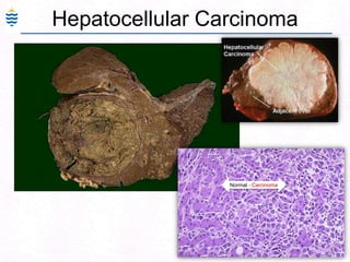 67
Hepatocellular Carcinoma
Normal - Carcinoma
 
