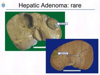 68
Hepatic Adenoma: rare
adenoma
adenoma
 