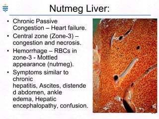69
Nutmeg Liver:
• Chronic Passive
Congestion – Heart failure.
• Central zone (Zone-3) –
congestion and necrosis.
• Hemorrhage – RBCs in
zone-3 - Mottled
appearance (nutmeg).
• Symptoms similar to
chronic
hepatitis, Ascites, distende
d abdomen, ankle
edema, Hepatic
encephalopathy, confusion.
 