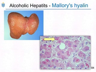 84
Alcoholic Hepatits - Mallory's hyalin
 