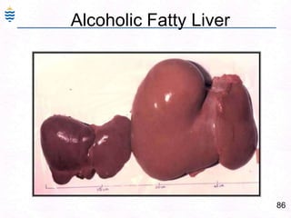 86
Alcoholic Fatty Liver
 