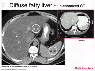 Diffuse fatty liver - un-enhanced CT.
Hamer O W et al. Radiographics 2006;26:1637-1653
©2006 by Radiological Society of North America
Normal
 