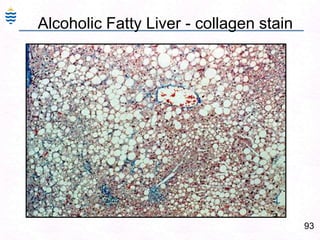 93
Alcoholic Fatty Liver - collagen stain
 