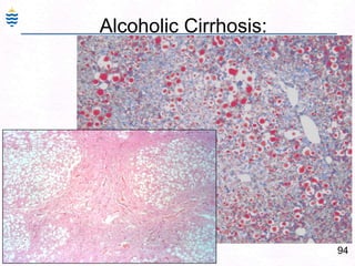 94
Alcoholic Cirrhosis:
 