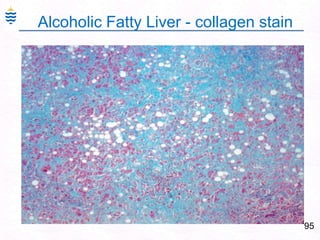 95
Alcoholic Fatty Liver - collagen stain
 