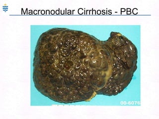 Macronodular Cirrhosis - PBC
 