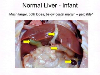 Normal Liver - InfantMuch larger, both lobes, below costal margin – palpable*