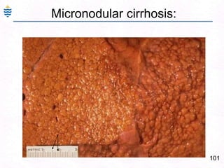 72Alcoholic Fatty Liver