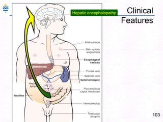 74Alcoholic Fatty Liver