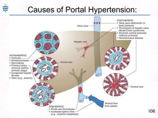 77Alcoholic Fatty Liver - CT