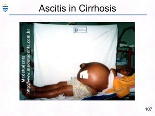 78Alcoholic Fatty Liver - CT