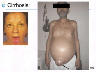 79Alcoholic Liver- Mallory's hyalin 