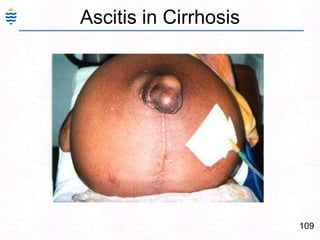 80Alcoholic Fatty change: