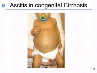 82Alcoholic Fatty Liver