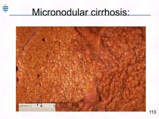 84Alcoholic Cirrhosis: