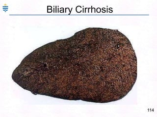 85Alcoholic Fatty Liver - collagen stain