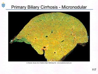 Drug Induced Zonal Hepatitis:88Autopsy specimen in a case of acetaminophen overdose.