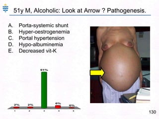 Fibrin thrombi in portal vessels.