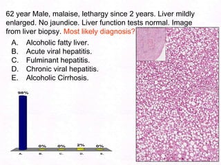 101Micronodular cirrhosis: