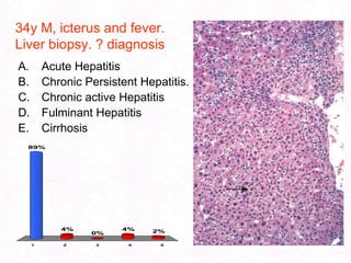 102Pathogenesis:Hepatocyte injury leading to necrosis.Alcohol, virus, drugs, toxins, genetic etc..Chronic inflammation - (hepatitis).Bridging fibrosis.Regeneration of remaining hepatocytes Proliferate as round nodules.Loss of vascular arrangement results in regenerating hepatocytes ineffective.