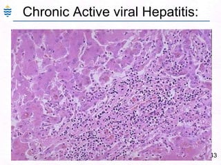 Complications of Hepatic Failure 