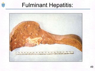 Viral Hepatitis: