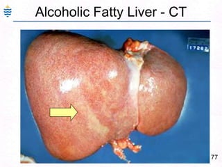 48Fulminant Hepatitis:Hepatic failure with in 2-3 weeks.Reactivation of chronic or acute hepatitisMassive necrosis, shrinkage, wrinkledCollapsed reticulin networkOnly portal tracts visibleLittle or massive inflammation – timeMore than a week – regenerative activityComplete recovery – or - cirrhosis.