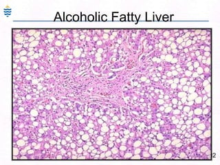 53Clinical Spectrum of HBV inf: