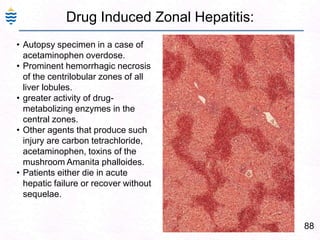 59Cirrhosis End stage of diffuse liver disease. scaring with regenerating nodules. (liver failure)Normal        Cirrhosis 
