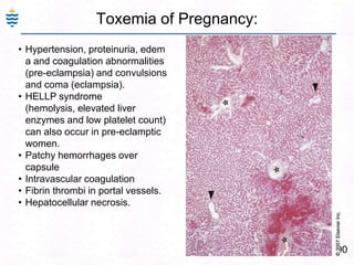 Alcoholic Liver Disease