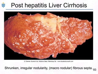 64Alcoholic Liver Injury:Ethyl alcohol : Common cause of acute/Chronic liver diseaseAlcoholic Liver disease - PatternsFatty change, Acute hepatitis (Mallory Hyalin)Chronic hepatitis with Portal fibrosis Chronic Liver failureCirrhosisAll reversible except cirrhosis stage.