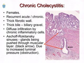 Chronic Cholecystitis: Females. Recurrent acute / chronic. Thick fibrotic wall. Thick bile – biliary gravel. Diffuse infiltration by chronic inflammatory cells. Aschoff-Rokitansky sinuses - glands being pushed through muscular layer. (black arrow). Due to increased luminal pressure (obstruction). 