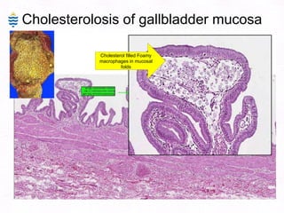 Cholesterolosis of gallbladder mucosa Cholesterol filled Foamy macrophages in mucosal folds 