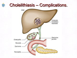Cholelithiasis – Complications. 