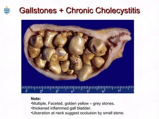 Gallstones + Chronic Cholecystitis Note: Multiple, Faceted, golden yellow – grey stones. thickened inflammed gall bladder. Ulceration at neck suggest occlusion by small stone. 