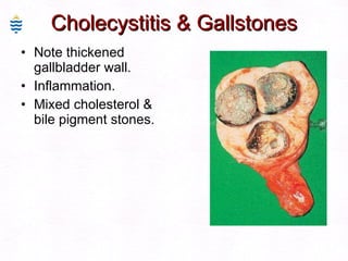 Cholecystitis & Gallstones Note thickened gallbladder wall. Inflammation. Mixed cholesterol & bile pigment stones. 