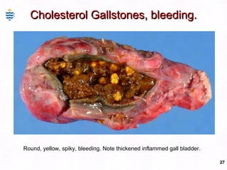 Cholesterol Gallstones, bleeding. Round, yellow, spiky, bleeding. Note thickened inflammed gall bladder. 